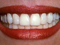 Программа «Красивые зубы»